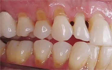 Sensitive Teeth Treatment