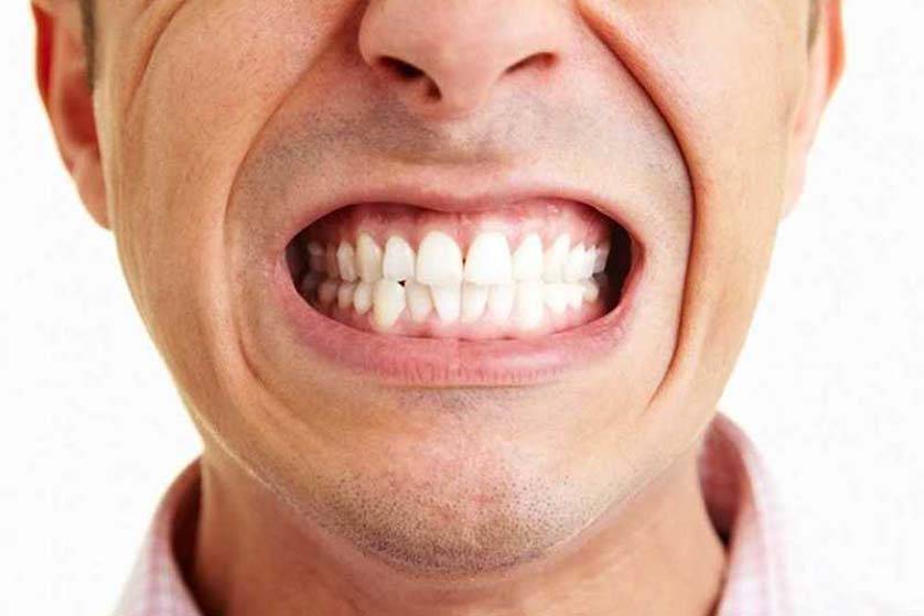 Bruxism - Teeth Grinding