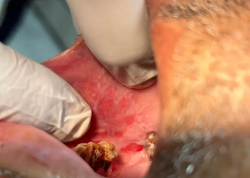 Lichen Planus & Other Autoimmune
