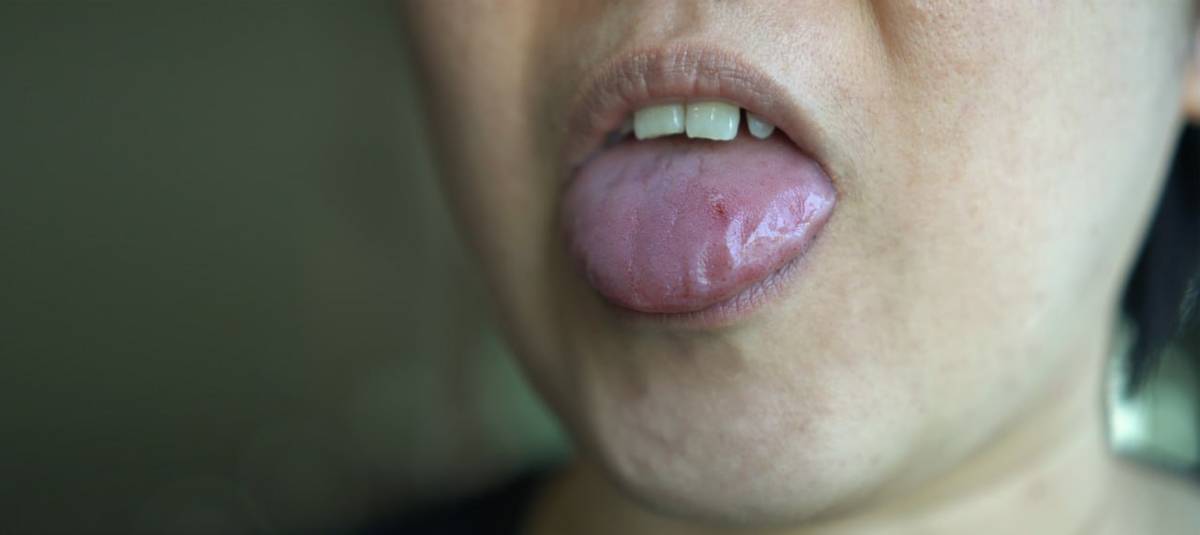 Oral Submucous Fibrosis